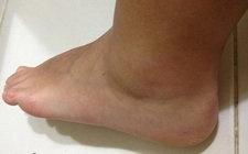 Doku Zedelenmesi Belirtileri ve Tedavisi Doku Zedelenmesi Belirtileri ve Tedavisi