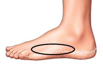 Ayakta Yumuşak Doku Zedelenmesi Belirtileri ve Tedavisi Ayakta Yumuşak Doku Zedelenmesi Belirtileri ve Tedavisi